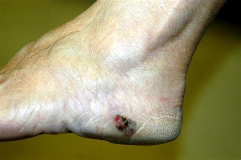 True Story of Surviving Skin Cancer on Feet - A Wake-up Call You Can't Ignore!