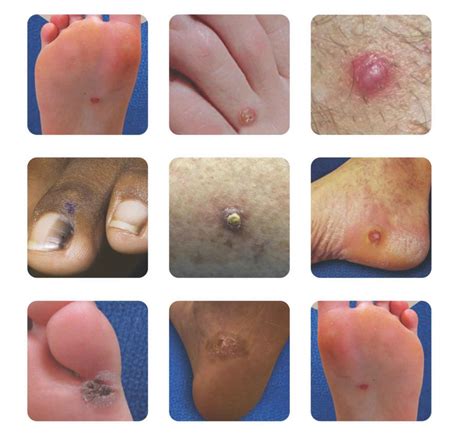 Protect Your Step: How Ignoring Skin Cancer on Your Foot Can Threaten Your Mobility and Happiness