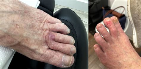 Step up Your Awareness: Skin Cancer on Toes - A Stealthy Threat Not to be Toe-d Around