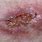 Skin Cancer Ulcer
