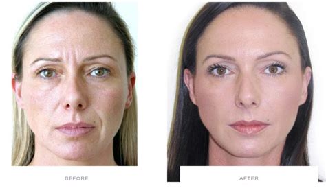 Radiant Retrieval: Unlocking the Secrets to Post-Botox Skin Care for a Glowing Visage