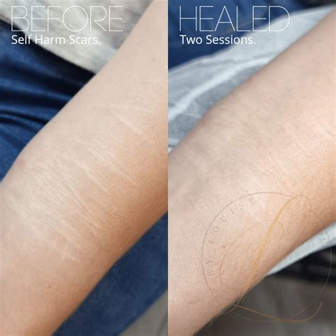 Shades of Confidence: How Skin Color Tattoo Can Transform Scar Cover-Up