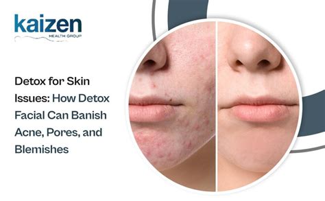 Revive Your Skin With A Detoxifying Makeover: Eradicate Acne Using The Power of Skin Detoxification!