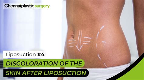 Unveiling the Truth about Post-Liposuction Skin Pigmentation: Understanding and Overcoming Skin Discoloration