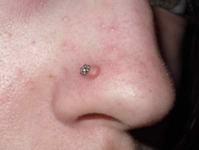 From Piercing to Perfection: How to Deal with Skin Growing Over Your Nose Piercing