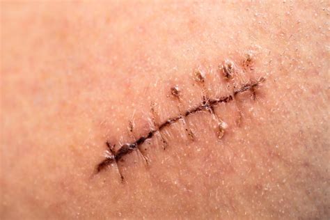 Compelling Story of Overcoming Pain and Healing: How Skin Grows over Stitches