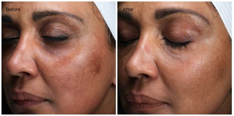 Transform Your Skin in Minutes: Witness the Astonishing Results of Skin Laundry Before and After