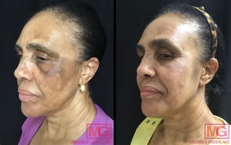 Illuminate Your Skin: Discover the Best Skin Lightening Services Near Me!