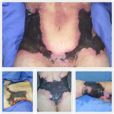 3 Ways to Prevent Skin Necrosis After Liposuction: Your Guide to Healthy and Safe Cosmetic Enhancement