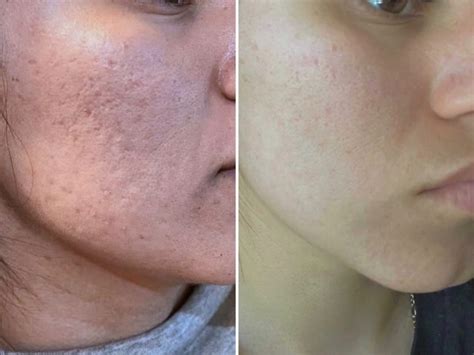 Revitalize Your Skin: Transform Acne Scars with the Miracle of Skin Needling!