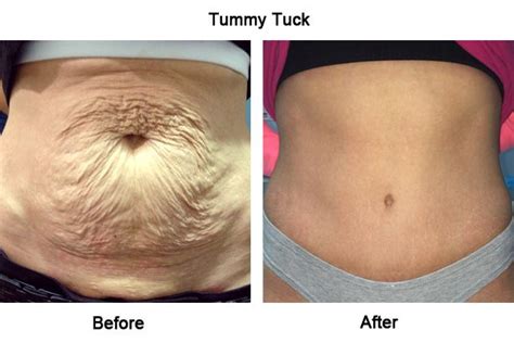 Flawless Contours Await with the Elegant Skin Only Tummy Tuck Procedure