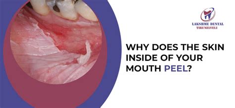 The Unveiling of Perfect Skin: Exploring the Phenomenon of Skin Peeling Inside Cheek