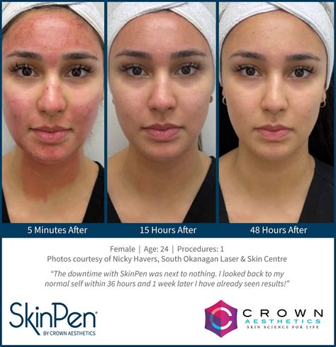 Transform Your Skin: Stunning Before and After Results with Skin Pen Microneedling!