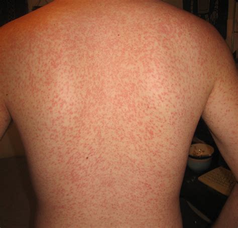 Uncovering the Mystery Behind Exercise-Induced Skin Rashes: Causes, Symptoms, and Treatment Options