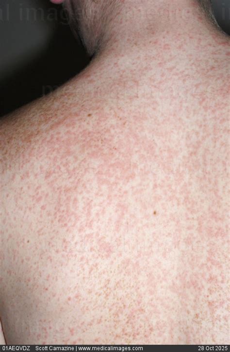 Uncovering the Itchy Truth: Debunking the Mystery Behind Skin Rash From Clindamycin