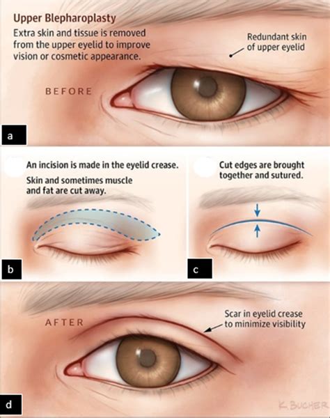 Skin Redundancy at Incision Ends