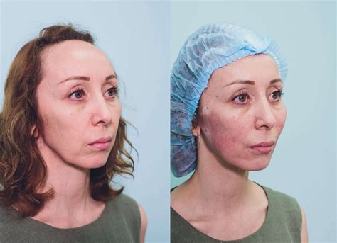 Transform Your Skin: See The Incredible Before and After Results of Our Skin Rejuvenation Treatment