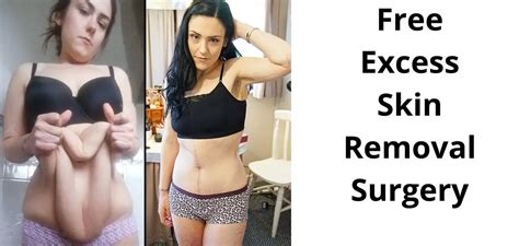 Beauty Unveiled: Locate The Best Skin Removal Surgery Near You!