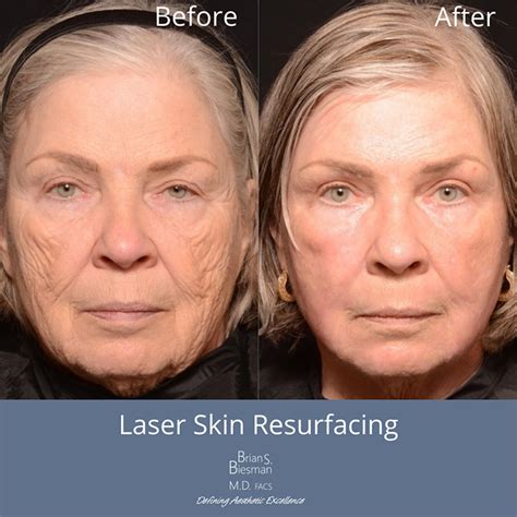 Revive Your Skin to Its Flawless Glory with Skin Resurfacing Near Me