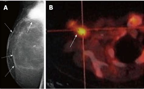 Maximizing Results: Skin Sparing Mastectomy Mammogram Explained