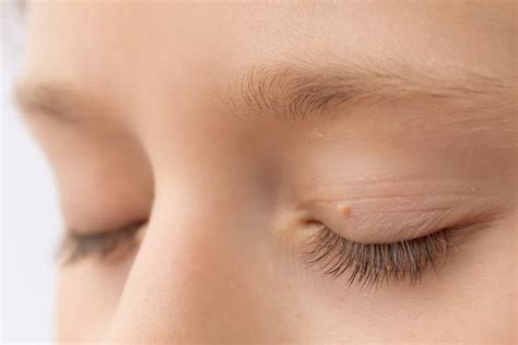 Get Rid of Unsightly Skin Tags Above Eye Fast!