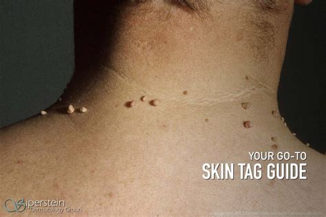 1. Say Goodbye to Skin Tags in Your Throat: Expert Tips for Smooth and Clear Breathing! 2. Tackling the Irritation of a Skin Tag Back of Throat – Your Ultimate Guide to Easy Swallowing! 3. Discover How to Get Rid of Pesky Skin Tags in Your Throat and Enjoy Full Comfort! 4. Experience the Relief You Deserve: Learn How to Eliminate Skin Tags at the Back of Your Throat! 5. No More Irritation and Discomfort: Overcoming Skin Tags at the Back of Your Throat Made Easy!