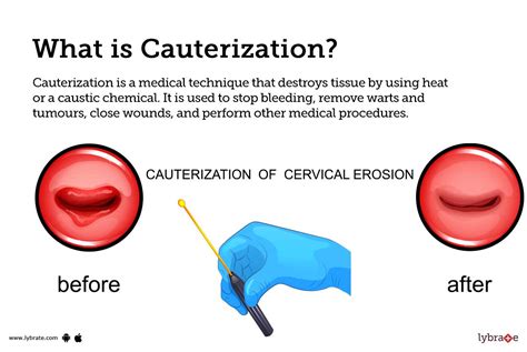 Quick Healing Time for Skin Tag Cauterization: Get Smooth Skin Fast