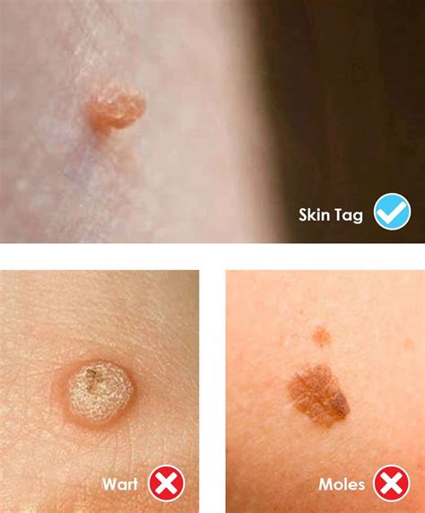 Uncover the Truth About Lingual Papillae: Your Ultimate Guide to Skin Tag in the Back of Throat