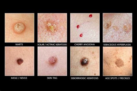 Unlocking the Pain-Free Path to a Smooth and Spotless Rear End: Your Ultimate Guide to Banishing Skin Tag in Butt Now!