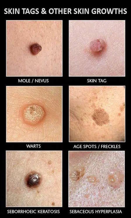 Unveiling the Truth Behind Skin Tags on Testicles: Causes, Symptoms and Effective Remedies