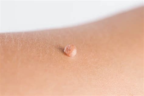 Say Goodbye to Pesky Buttcrack Skin Tags with These Remedies