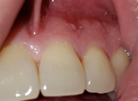 Say Goodbye to Oral Imperfections: Flying Through the Facts On Skin Tags on Gums