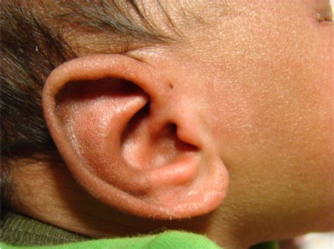 The Heartbreaking Reality: Newborn Baby Suffers from Painful Skin Tag on Ear