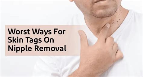 How to Effortlessly Bid Farewell to Your Skin Tag on Nipple for a Clear and Flawless Skin