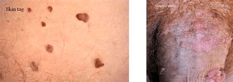 The Most Embarrassing Problem You Don't Want On Your Penis: How to Get Rid of That Skin Tag Now