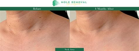 Skin Tag Be Gone: Schedule Your Appointment for Safe and Painless Skin Tag Removal Today