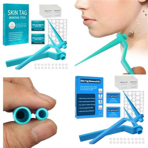 10 Effective Ways to Remove Skin Tags with Rubber Bands.