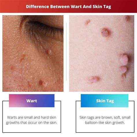 Unmasking the Differences Between Skin Tags and Warts: A Comprehensive Guide