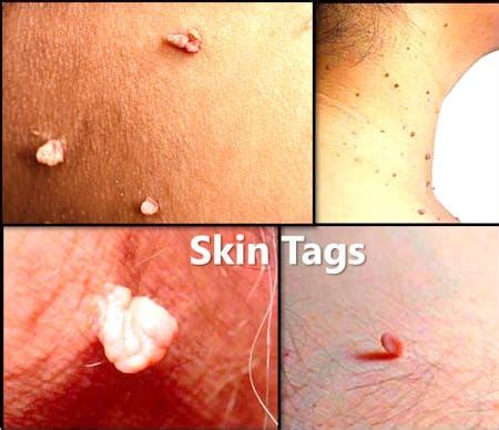 Skin Tag vs HPV: Key Differences and Similarities