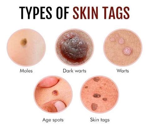 Pregnancy Blues: Dealing with Skin Tags - A Guide to Safe Removal During Pregnancy