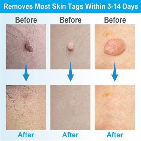 Removing Skin Tags on Bikini Line: Tips and Tricks