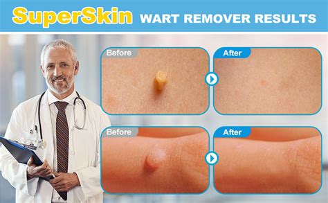 Flawlessly Flaunt Your Skin with Our Innovative Skin Tags Removal Tool