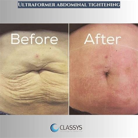 Flaunt a Taut Tummy with Our Top Skin Tightening Machine for Stomach - Get Your Dream Abs with Ease!