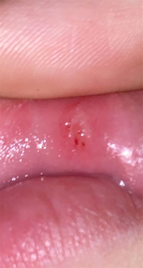 Small Red Dot On Lower Lip