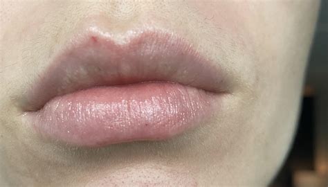 Small Red Dot On My Lip