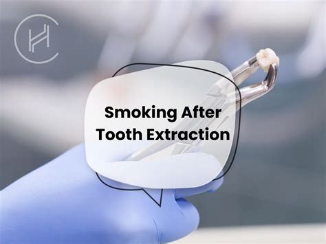 Smoking After Tooth Extraction