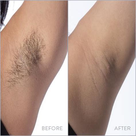 Smooth Armpits: Safe Hair Removal Tips