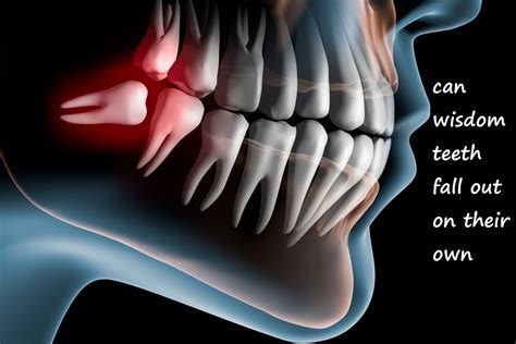 So, Can Wisdom Teeth Actually Fall Out on Their Own