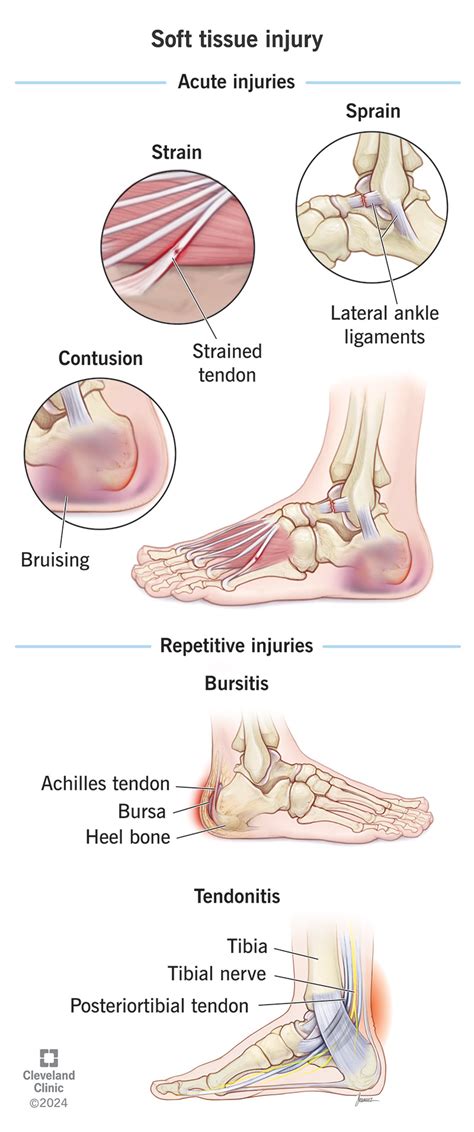Soft Tissue Injuries