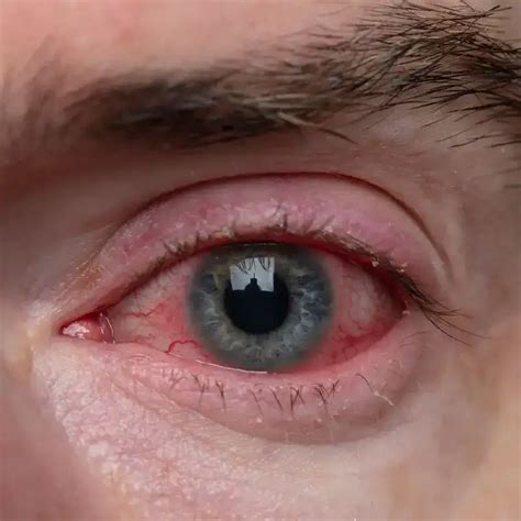 Sore Eyes & Discharge: Find Your Relief.